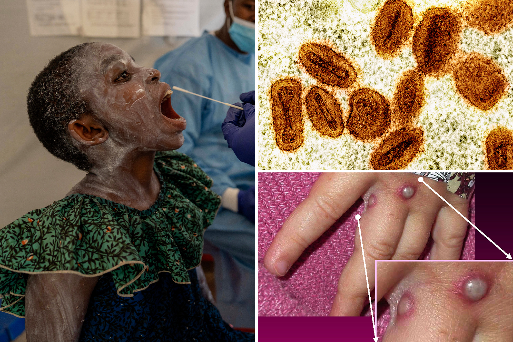  New mpox strain confirmed in NY for the first time