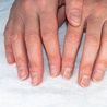  Unexpected lung cancer symptom on fingernails you should never ignore