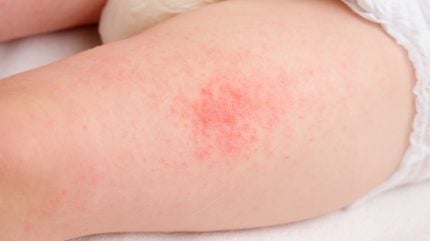  First child enrolled in Arcutis’ trial of atopic dermatitis cream