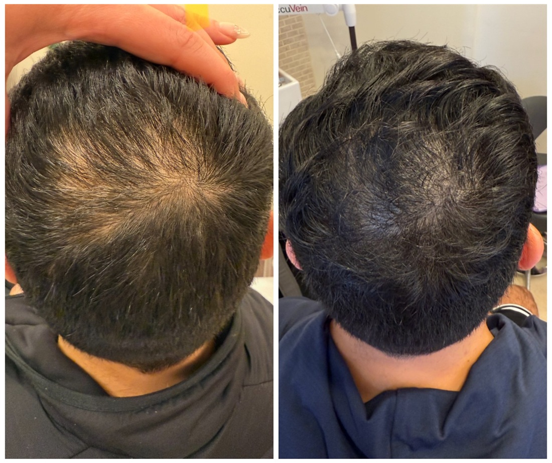 Hair Restoration: A Journey, Not a Single Treatment
