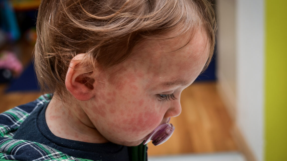  Child dies of horrifying measles complication in Los Angeles