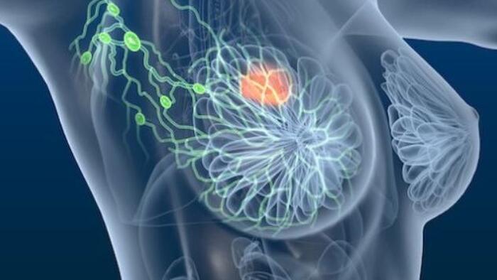 FDA Approves New Therapy For Advanced Breast Cancer