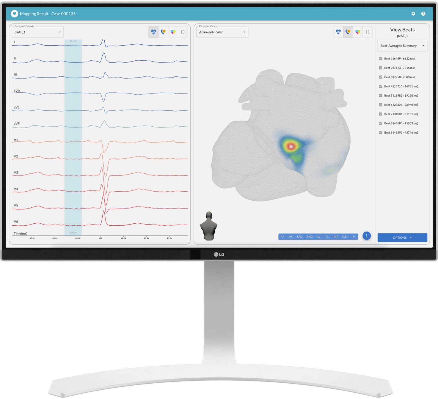  Vektor Medical Secures CE Mark for vMap, Bringing the Benefits of Non-Invasive Arrhythmia Mapping to Europe