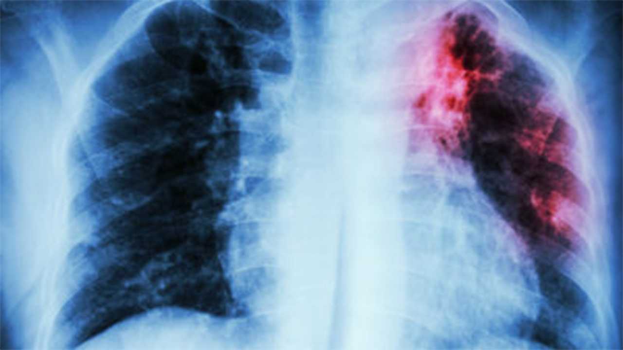 2 people diagnosed with tuberculosis were in Manchester, Nashua while infectious