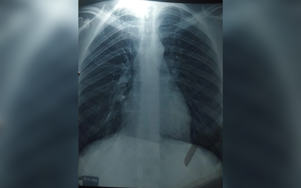 Man Gets X-Ray After ‘Weird Hiccups’ Begin—Then Doctors Spot the Problem