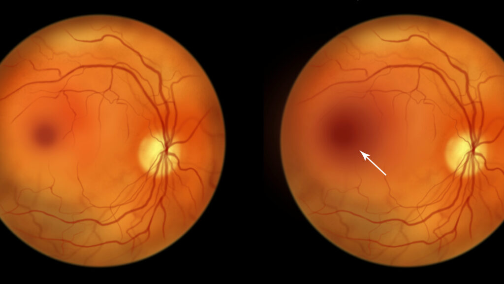 STAT+: Ophthalmology venture grabs investors’ attention, raises $330 million